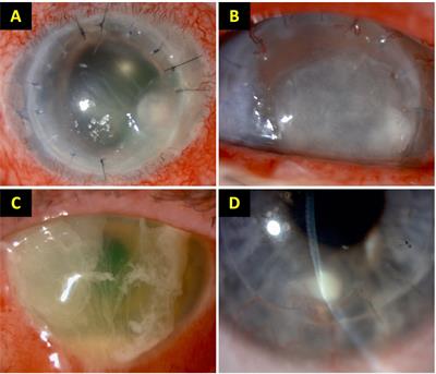 A 7-year review of clinical characteristics, predisposing factors and outcomes of post-keratoplasty infectious keratitis: the Nottingham infectious keratitis study